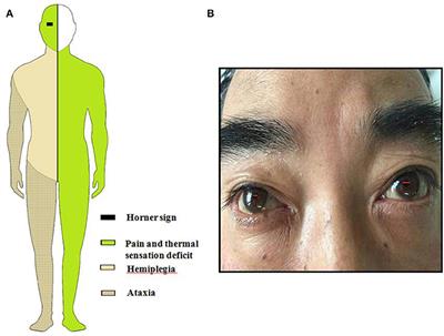 Comorbid SUNCT Syndrome and Opalski Syndrome Caused by Dorsolateral Medullary Infarction